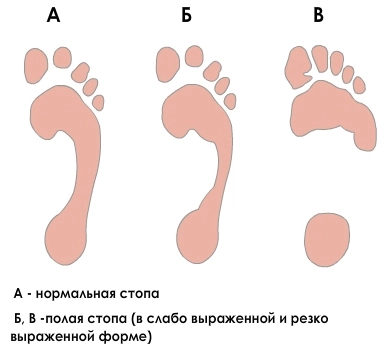 Отпечаток стопы в норме и при плоскостопии