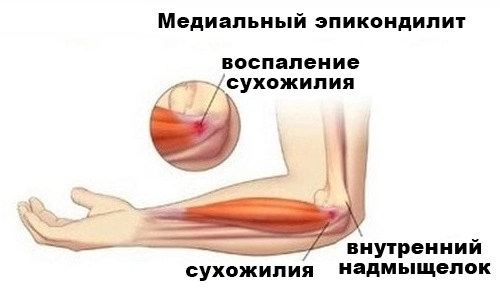 Воспаление сухожилия при эпикондилите