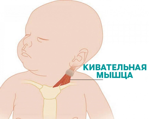 Врождённая кривошея