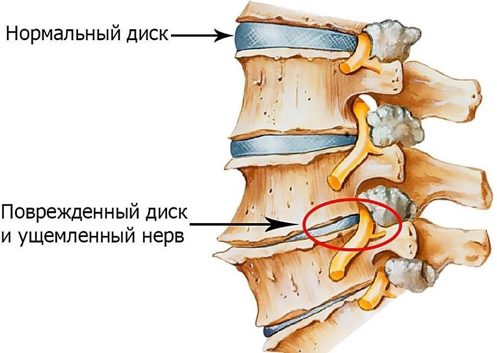 Как выглядит радикулит