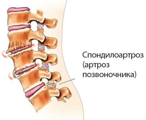Спондилоартроз грудного отдела