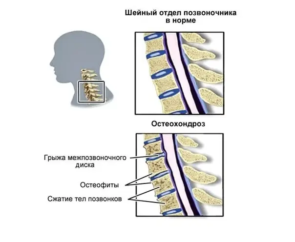 Шейный остеохондроз