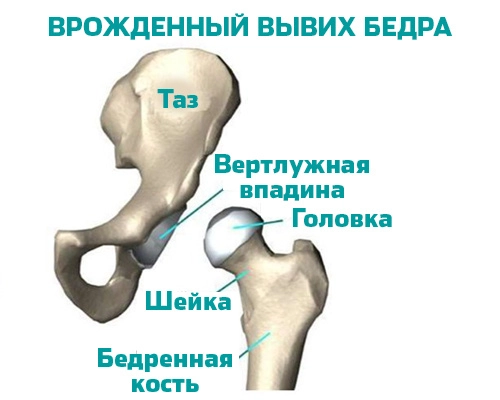 Врождённый вывих бедра