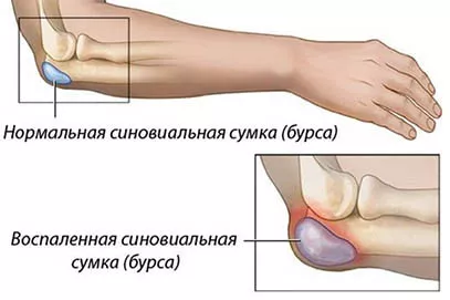 Как выглядит бурсит