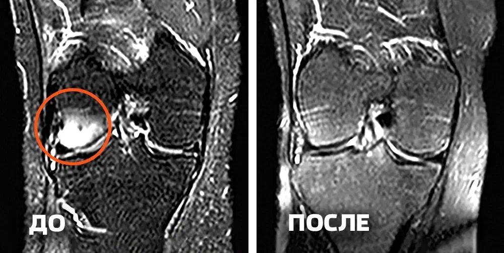 Через 4 месяца колени, как новые!