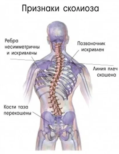 Что будет, если не лечить сколиоз?