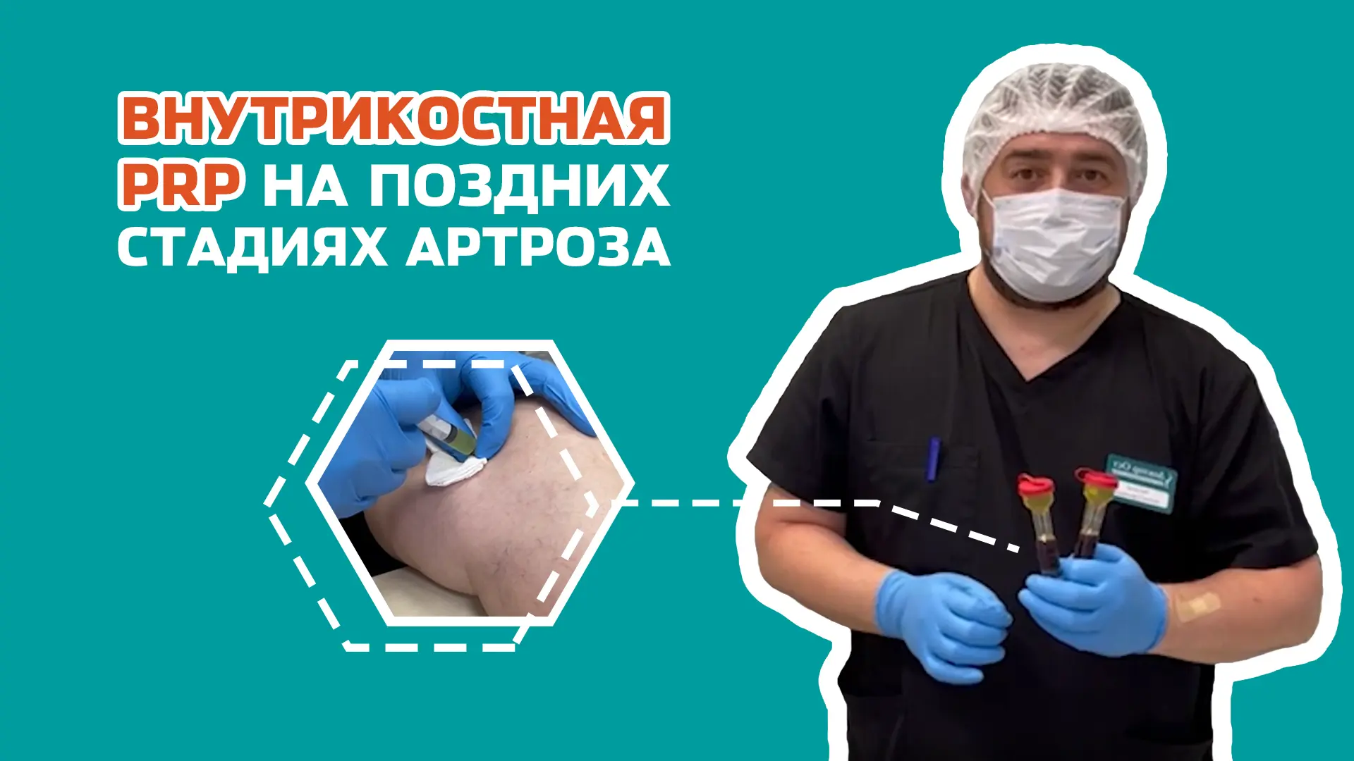 Как работает внутрикостная PRP терапия