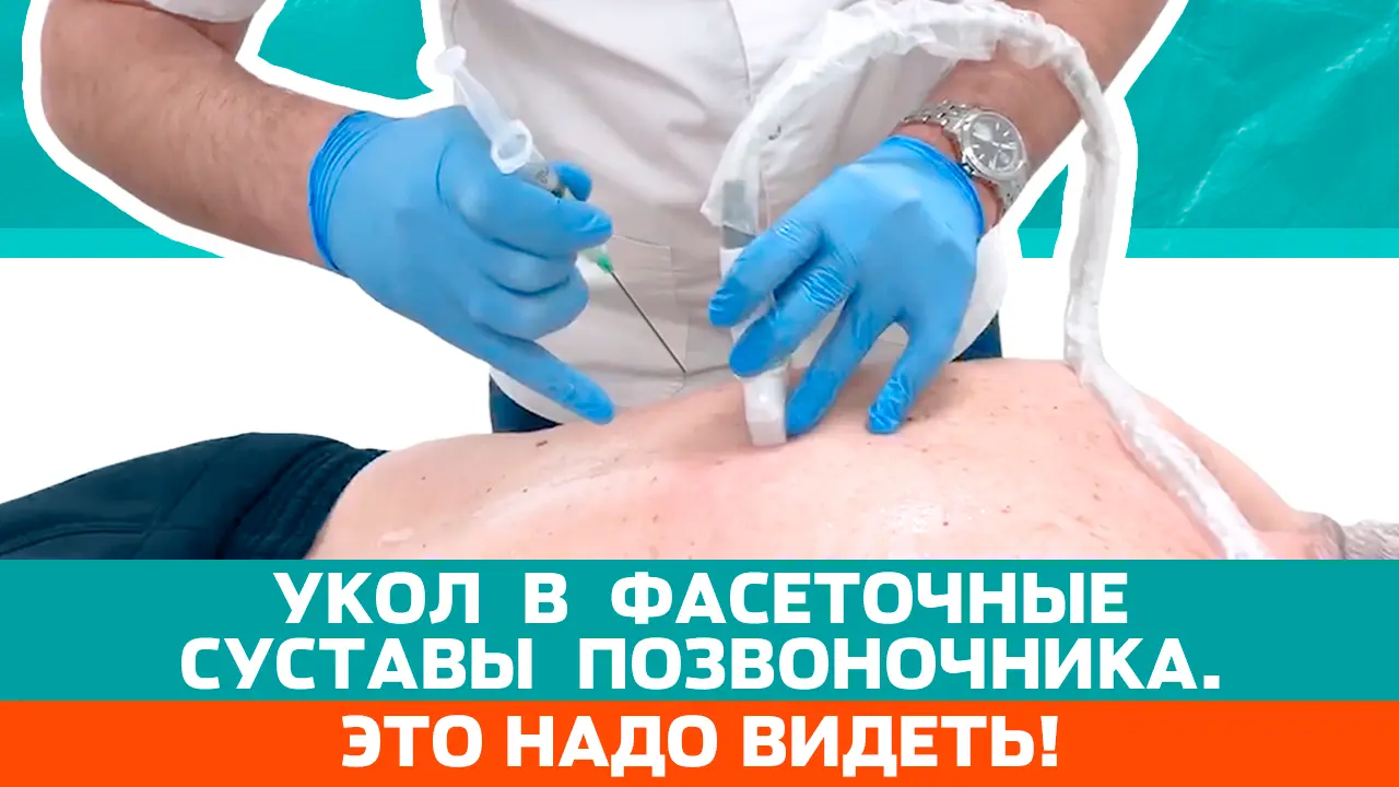 Лечение артроза спины плазмогелем